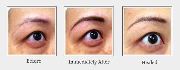 Powdered Eyebrow – Before, Immediately After, Healed ...